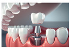 Which Health Conditions Affect Dental Implants in Richmond?