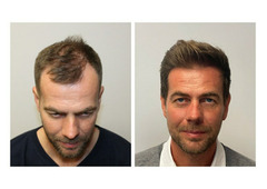 Hair Loss Solution Dallas