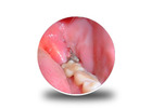 Immediate Relief for Wisdom Teeth Infections